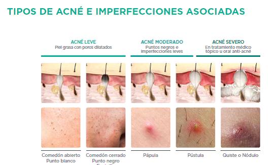 Qué es el acné? | CinfaSalud