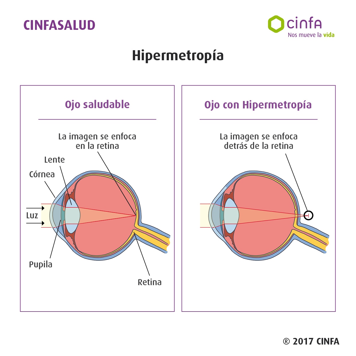 hipermetropia alta infantil chirurgie pentru îmbunătățirea consecințelor vederii