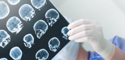 ¿La epilepsia se puede curar?