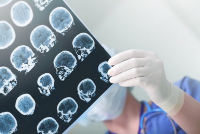 ¿La epilepsia se puede curar?