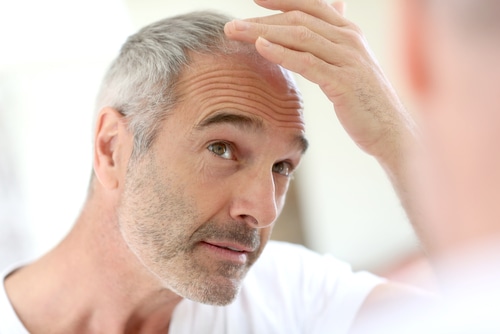 ¿La alopecia se puede frenar?
