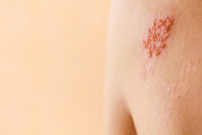 ¿Qué es el herpes zóster?