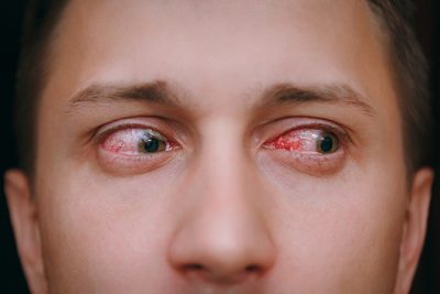 La conjuntivitis puede ser vírica o bacteriana.