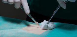 ¿Qué síntomas alertan de que sufro apendicitis?