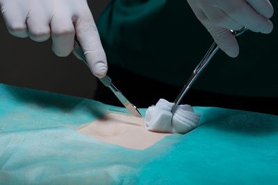 ¿Qué síntomas alertan de que sufro apendicitis?