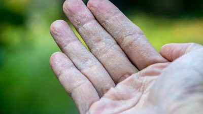 ¿Qué síntomas provoca la dishidrosis? CinfaSalud