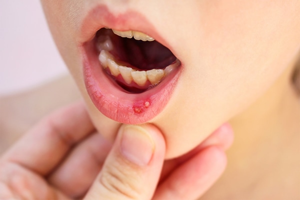 Qué es la enfermedad boca-mano-pie? Síntomas | CinfaSalud