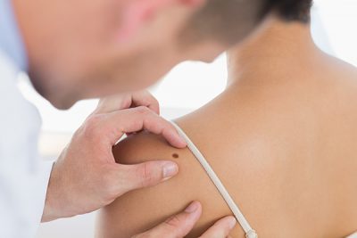 La exposición excesiva al sol es una de las causas de la aparición de melanoma. CinfaSalud