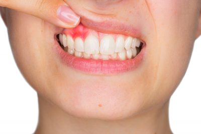 ¿Qué síntomas presenta la periodontitis? CinfaSalud