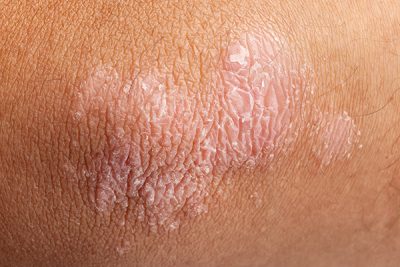 Tratamiento de la Psoriasis. CinfaSalud