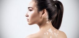 ¿Se pueden eliminar las manchas del vitíligo? CinfaSalud