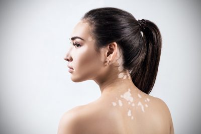 ¿Se pueden eliminar las manchas del vitíligo? CinfaSalud