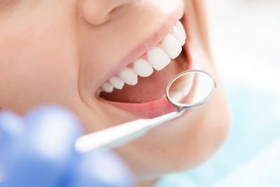 ¿Cómo actuar ante la gingivitis?