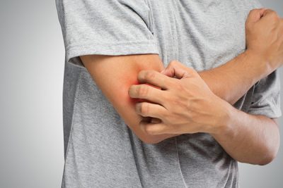 ¿Qué síntomas produce la urticaria?
