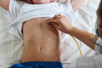 ¿Cómo evitar el contagio de sarampión? CinfaSalud
