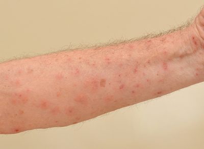 ¿Cuánto tiempo dura la sarna? CinfaSalud