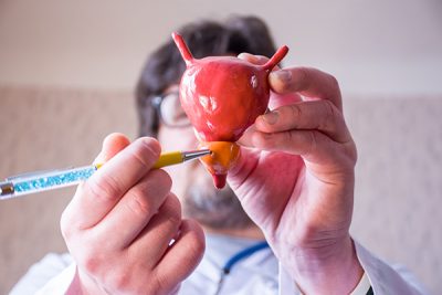 El agrandamiento de la próstata no es un cáncer de próstata.