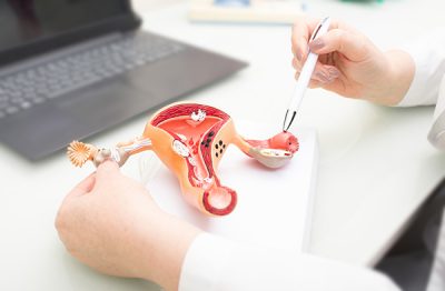 El cáncer de endometrio es uno de los tumores ginecológicos más frecuentes.