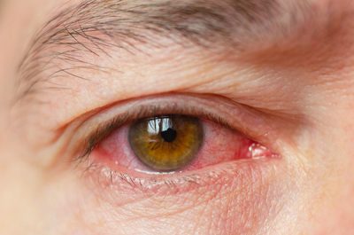 Una úlcera corneal es una herida en la córnea del ojo.