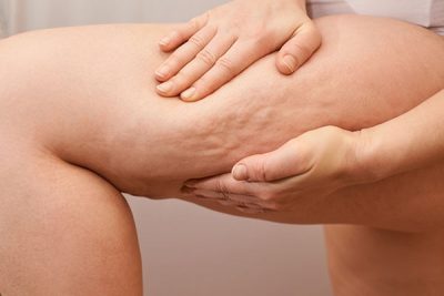 La acumulación de grasa bajo la piel es lo que forma la celulitis.