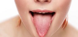 La leucoplasia oral es una placa blanca de la mucosa oral.