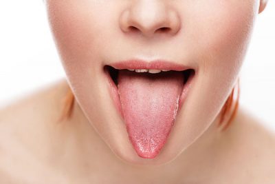 La leucoplasia oral es una placa blanca de la mucosa oral.