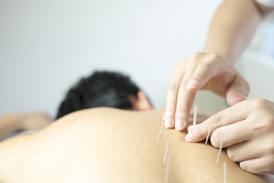 Uno de los tratamientos del dolor crónico es la acupuntura. 