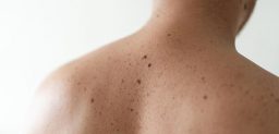 La queratosis actínica es una lesión que aparece en la piel tras la exposición al sol.