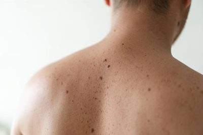 La queratosis actínica es una lesión que aparece en la piel tras la exposición al sol.
