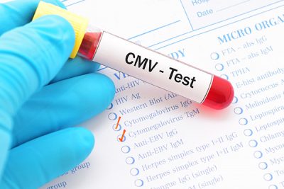 El citomegalovirus es un virus de la familia de los herpesvirus