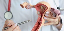 El cáncer de ovario se produce como consecuencia de una acumulación de alteraciones genéticas, que causa un crecimiento de células epiteliales.
