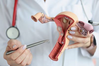 El cáncer de ovario se produce como consecuencia de una acumulación de alteraciones genéticas, que causa un crecimiento de células epiteliales.