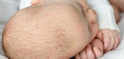 La dermatitis seborreica es un trastorno inflamatorio crónico de la piel muy común.