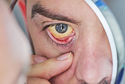 Los signos y síntomas más comunes de las talasemias van desde la anemia, la dificultad para concentrarse, a icteria o coloración amarillenta del blanco de los ojos, entre otros.