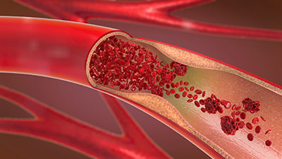 Las obstrucciones de las arterias son debidas a la presencia de placas llenas de grasa.