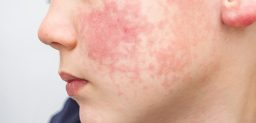 La Dermatomiositis Juvenil es una enfermedad autoinmune que produce inflamación en los vasos sanguíneos de la piel y del músculo.
