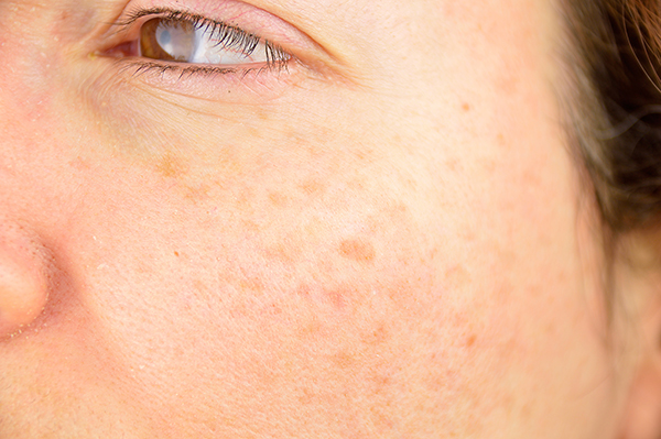 Vista de cerca de dermatitis seborreica: MedlinePlus enciclopedia