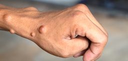 Las neurofibromatosis son un grupo de enfermedades de origen genético.