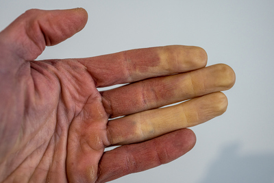 El síndrome de Raynaud puede provocar cambio en la coloración de la piel, hinchazón y sensación de hormigueo o entumecimiento y dolor. 