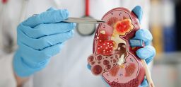 La nefropatía diabética es una complicación grave de diabetes tipo I y II y se trata de una de las causas más comunes de enfermedad renal.
