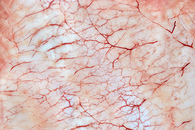 La vasculitis es la inflamación de los vasos sanguíneos, de cualquier territorio vascular (arterial o venoso).