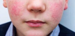 El eritema infeccioso, megaloeritema o también es conocida como la “enfermedad de la bofetada o del cachete”