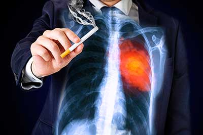 La fibrosis pulmonar idiopática es minoritaria, ya que se producen entre 13 y 20 casos por cada 100.000 habitantes, según la SEPAR.