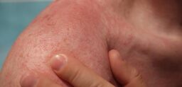 La popularmente conocida como alergia al sol engloba un conjunto de afecciones que se caracterizan por una reacción anormal o adversa de la piel que la exposición a la luz solar desencadena o agrava