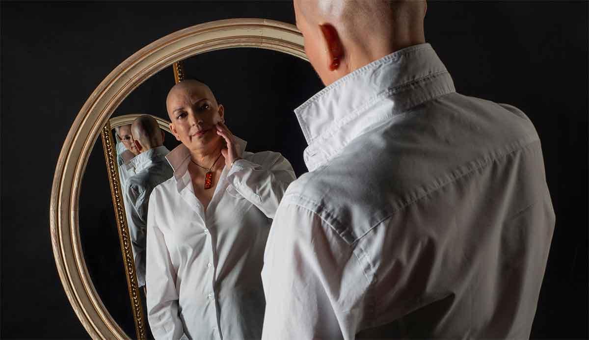 La alopecia areata es una pérdida anormal del cabello de origen autoinmune.