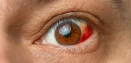 El derrame ocular es una pequeña acumulación de sangre debido a la rotura de uno o varios de los numerosos vasos sanguíneos capilares que se hallan en la superficie del ojo.