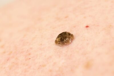 Las queratosis seborreicas no se malignizan, no son contagiosas y, en general, no representan ningún riesgo para la salud.