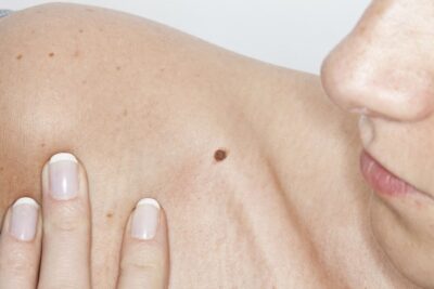 Los tumores cutáneos son lesiones que pueden originarse en la epidermis, dermis, hipodermis, anexos, vasos y nervios.