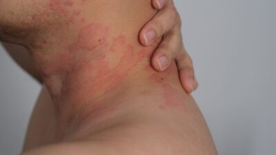 Más común en los climas cálidos y húmedos y en adultos mayores y obesos