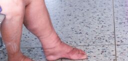 La filariasis linfática es conocida también como elefantiasis.